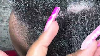 ITCHY DRY SCALP  FLAKY  DANDRUFF HAIR SCRATCHING ASMR [upl. by Adan722]