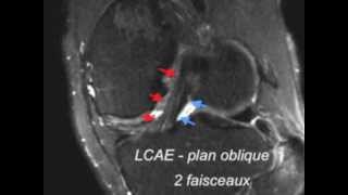 Ligament croise anterieur  normal  IRM 3D [upl. by Krid]