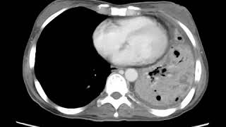 Necrotizing pneumonia Axial CECT Essential Radiology for Medical Students Interns and Residents [upl. by Atsirak]