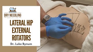 Dry Needling Lateral Hip External Rotators [upl. by Aiotal]