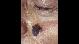 Squamous Cell Carcinoma and Lentigo Maligna Melanoma plus the precancerous conditions [upl. by Notfa428]