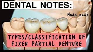 TYPES OF FIXED PARTIAL DENTURE II VARIOUS CLASSIFICATION II PROSTHODONTICS II imp [upl. by Eelirem]