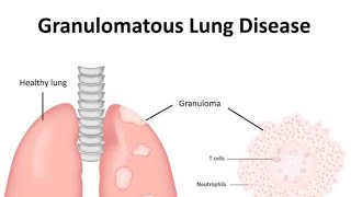 Granulomatous diseases of Lung Introduction [upl. by Aratehs]