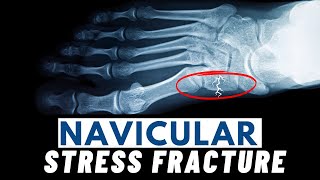 Navicular Stress Fractures  Symptoms Causes Diagnosis amp Treatment [upl. by Arabela]