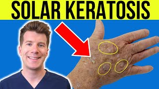 Doctor explains Actinic Solar Keratosis  Sun damaged skin  causes symptoms and treatment [upl. by Hilleary301]