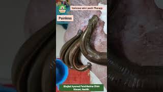 Varicose vein Leech Therapy ayurveda panchkarma hirudoterapia leechtherapy vericoseveins [upl. by Aihsenak]