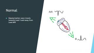 Cardiac Axis Presentation Video [upl. by Oinegue992]