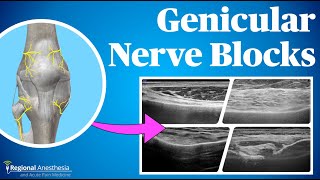 Ultrasound Guided Genicular Blocks 2024 update [upl. by Annerahs]