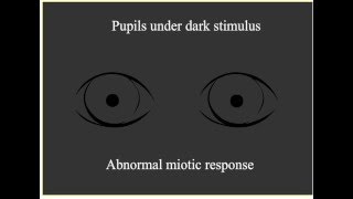 Paradoxical Pupillary Response [upl. by Hugh]