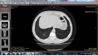 CTAbdomen nativ Harnleiterstein mit Nephritis [upl. by Alemac]