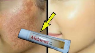 Melamet Cream How To Use  Detail Review in Hindi  Melamet Cream Remove Pigmentation  Melasma [upl. by Otiragram]