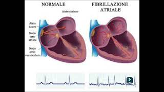 fibrillazione atriale [upl. by Dugaid]