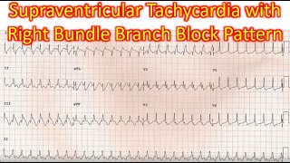 Supraventricular Tachycardia with Right Bundle Branch Block Pattern [upl. by Yablon]