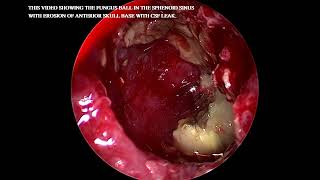 Fungal ball in Sphenoid sinus with erosion of skull base [upl. by Mauldon]