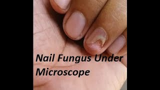 How does a nail fungus look like under Microscope [upl. by Farkas414]