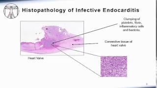 Endocarditis Pathophysiology [upl. by Rodrich]