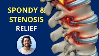 RELIEF from Spondylolisthesis and Stenosis [upl. by Laurie]