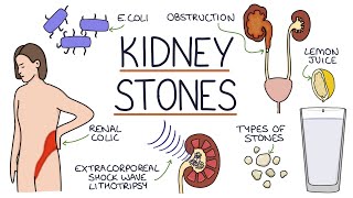 Understanding Kidney Stones [upl. by Ehsiom]