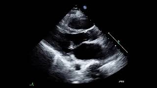 Anterior mitral leaflet doming in mitral stenosis  Hockey stick sign [upl. by Henleigh]