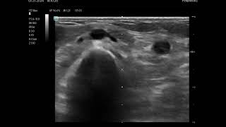 Ultrasound Guided IV Insertion Tips and Tricks Understanding Sonographic Images [upl. by Ezirtaeb]