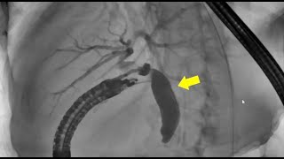 FLORIDA LIVE AUG 2224 2024 VIDEO  WHY EUS HAS NOT REPLACED ERCP FOR BILIARY DECOMPRESSION [upl. by Carie469]