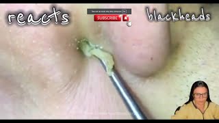 blackheads nose blackheads nose removal blackheads nose extraction blackheads nose tweezers [upl. by Graig]