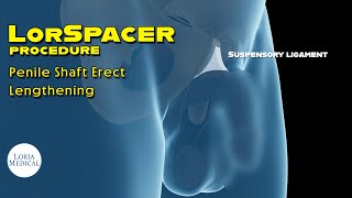 Suspensory Ligament Release procedure How its done [upl. by Pallas]