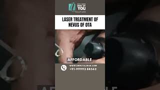 Treatment of Nevus of OTA Removal Procedure Laser Treatment of Nevus of OTA in Delhi Dr PK Talwar [upl. by Anelaj259]