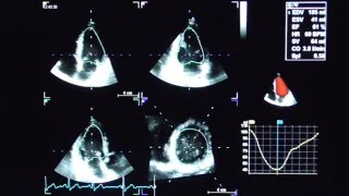 4D AUTO LVQ STRAIN WITH LV AREA [upl. by Clabo]