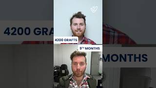 FUE Hair Transplant Results Month by Month  4200 GRAFTS 🫨 [upl. by Ariela]