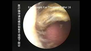 Regular cholesteatoma reexamination and cleaning of the ear [upl. by Otrebire782]