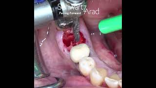 An elegant technique for immediate implantation in molars [upl. by Wivinah239]