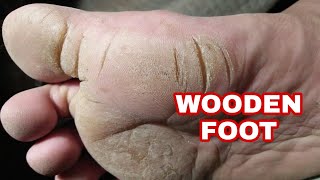 Wooden foot  Extreme Callus Growth [upl. by Okimuy]