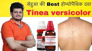 सेहुआ की Best Homeopathic Medicine  Tinea versicolor Remove Combination  How to Use [upl. by Aveer]