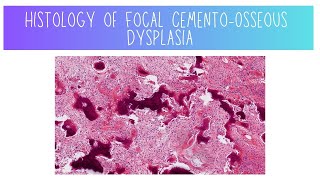 Histology of Focal CementoOsseous Dysplasia [upl. by Yddub]