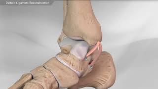 Entorse de cheville ligament deltoide interne  Chirurgie ligamentoplastie  Dr Simon Tournemine [upl. by Assirrec]