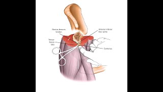 Anterior Inferior Iliac Spine External fixation pin placement [upl. by Naerol233]