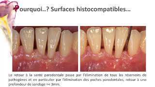 le Détartrage surfaçage radiculaire Un acte de bonne pratique [upl. by Shevlo]