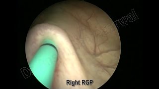 Holmium Laser Endopyelotomy by Dr Anshuman Agarwal [upl. by Philo]