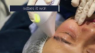 Dark Eye Circles Treatment Eye Rejuvenation amp Lift  EndyMed iFine [upl. by Wilde]