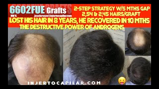 6602Grafts NWV Lost his hair in 8yrs recovered in 10mths 2step strategy w5 mths gap 28892023 [upl. by O'Toole]