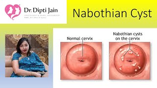 Nabothian cysts HINDI [upl. by Euqinimod]