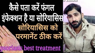 कैसे पता करें फंगल इंफेक्शन है या सोरियासिस।psoriasis best herbal treatment [upl. by Semreh]