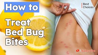 12 Easy Steps to Treat Bed Bug Bites  How to Treat Bed Bug Bites  Best choices [upl. by Attolrac585]