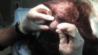 Pilar Cyst Removal on the Scalp [upl. by Ahsat]