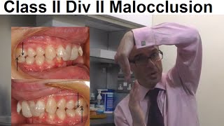 Why Class II Division II Malocclusion Inclined Teeth is Less Common in People by Dr Mike Mew [upl. by Toth]