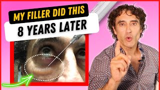 MY UNDER EYE FILLER REACTION 8 YEARS LATER And HOW IM FIXING IT [upl. by Anayaran]