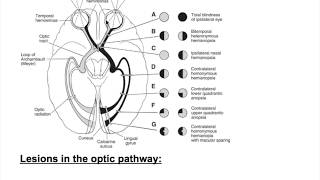 Optic nerve lesions Bitemporal hemianopia heteronymous hemianopiaHomonymous hemianopia [upl. by Cyrill]