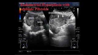 Endometrial Hyperplasia with multiple Fibroids [upl. by Valenka]