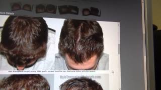 2000 graft FUT with Strategy  Feller and Bloxham Hair Transplant [upl. by Michel]